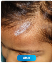 After SkinSeal