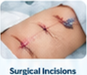 Surgical Incisions
